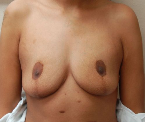 Massive Weight Loss : Case 10 - Before