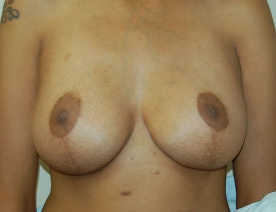 Massive Weight Loss : Case 10 - After