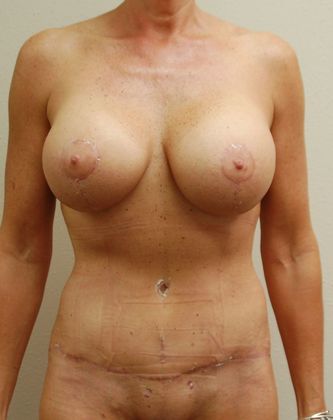 Mommy Makeover Case 4 - After