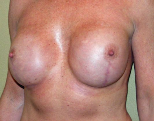 Breast Reconstruction: Case 9 - Breast Reconstruction After