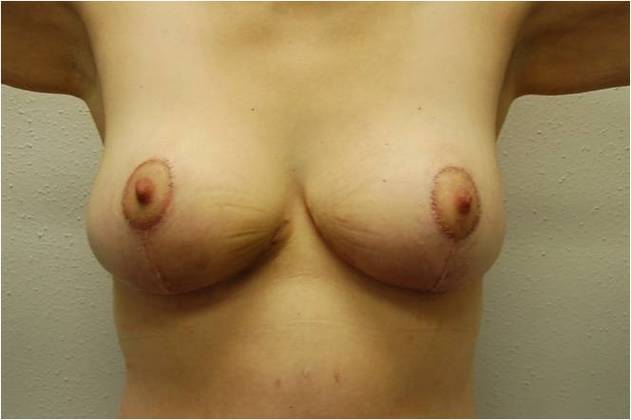 Massive Weight Loss : Case 8 - After