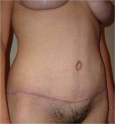 Massive Weight Loss : Case 1 - After