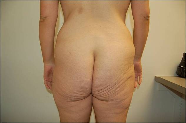 Massive Weight Loss : Case 1 - Before