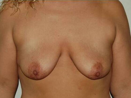 Breast Augmentation w/ Lift Case 25 - Before