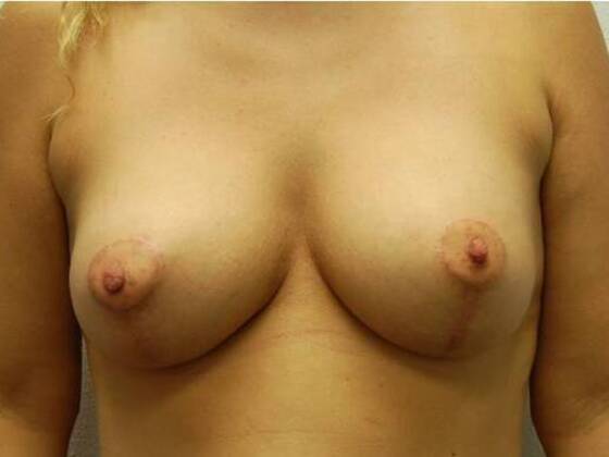 Breast Augmentation w/ Lift Case 25 - After