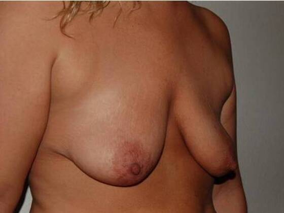 Breast Augmentation w/ Lift: Case 25 - Before