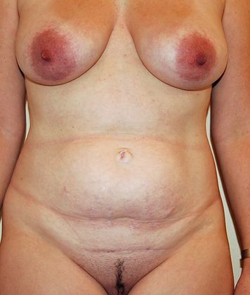 Mommy Makeover Case 9 - Before