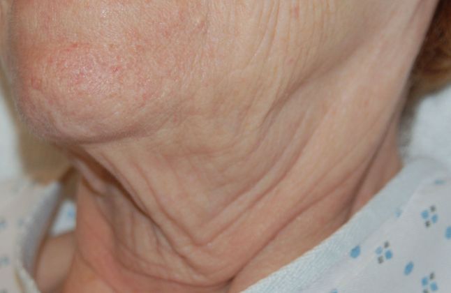 Facelift Case 1 - Before