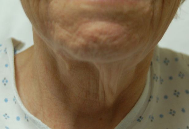 Facelift: Case 1 - Before