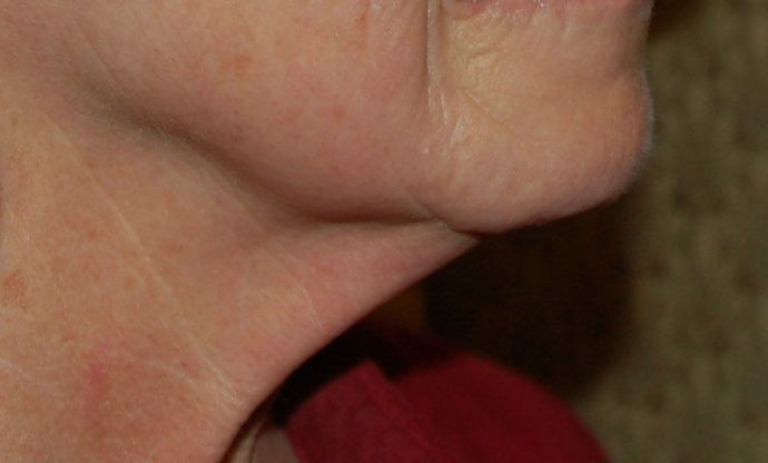 Facelift: Case 2 - Before