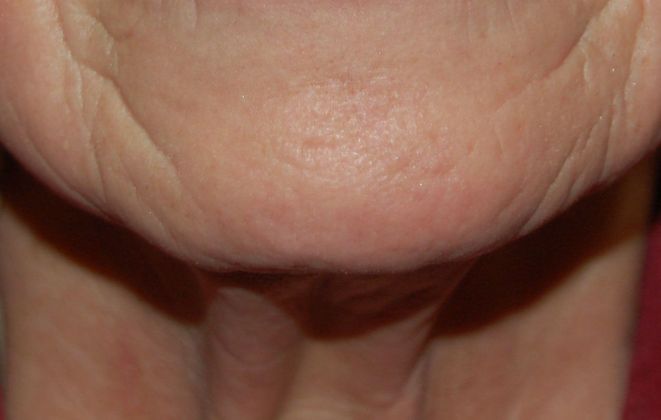 Facelift: Case 2 - Before