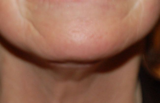Facelift: Case 2 - After