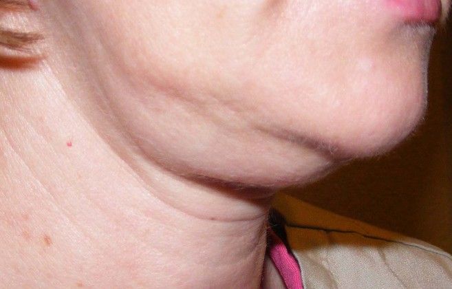 Facelift Case 3 - Before