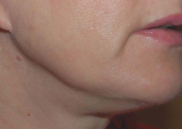 Facelift Case 3 - After