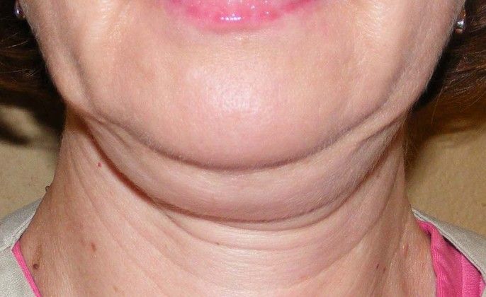 Facelift: Case 3 - Before