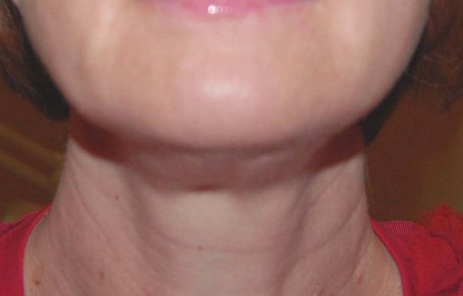 Facelift: Case 3 - After