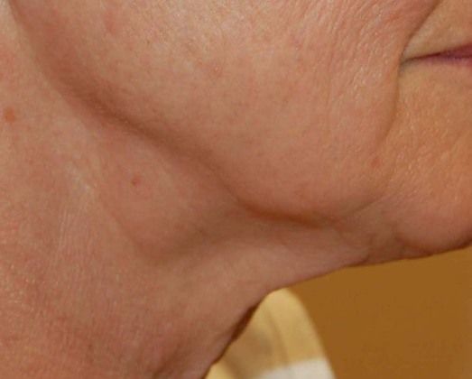 Facelift Case 4 - Before