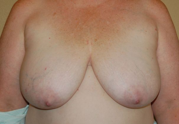 Breast Reconstruction Case 21 - Before