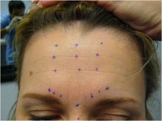 Botox: Case 1 - Before