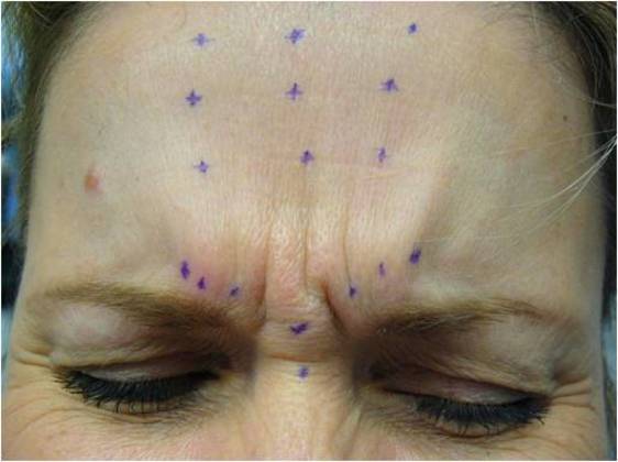 Botox: Case 1 - Before