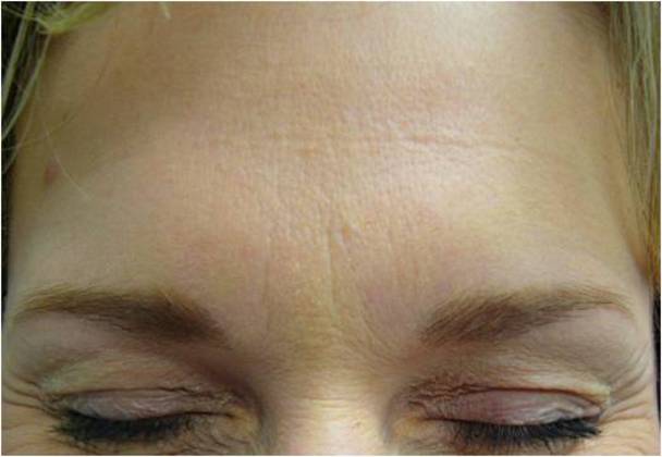 Botox: Case 1 - After