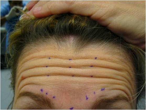 Botox: Case 1 - Before