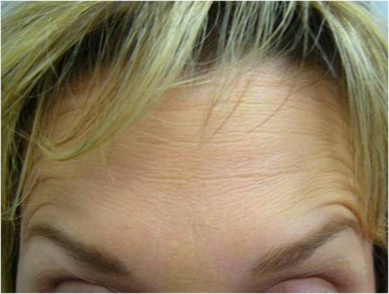 Botox: Case 1 - After