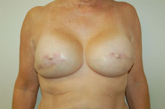 Breast Reconstruction Case 23 - After