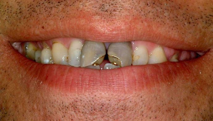 Porcelain Crowns: Case 5 - Smile Before