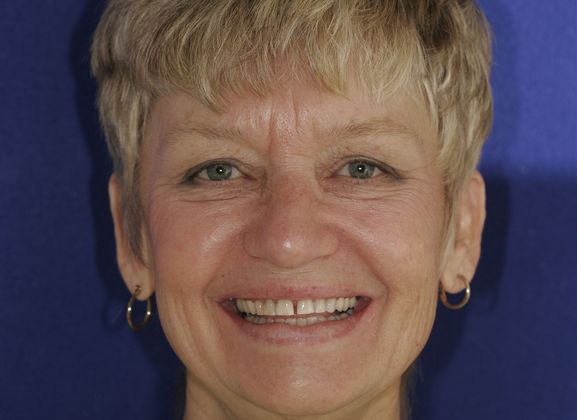 Veneers: Case 28 - Before