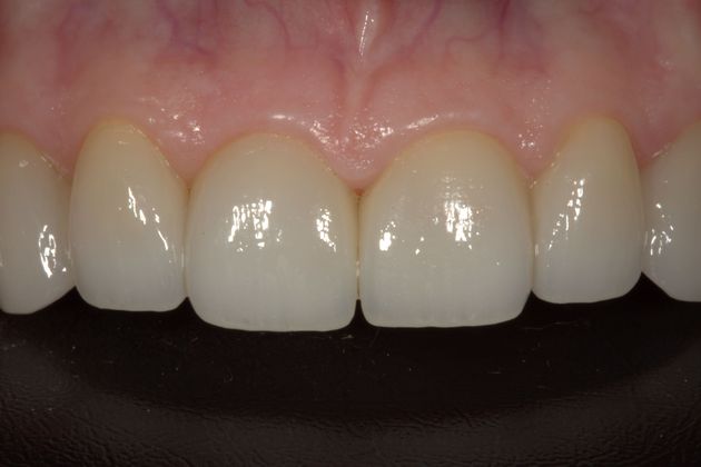 Veneers Case 30 - After