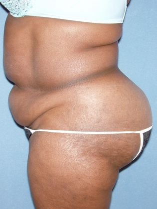 Liposuction: Case 7 - Before - Side