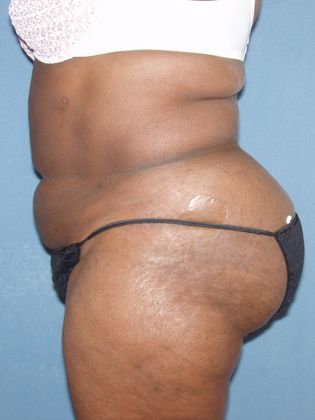 Liposuction: Case 7 - After - Side