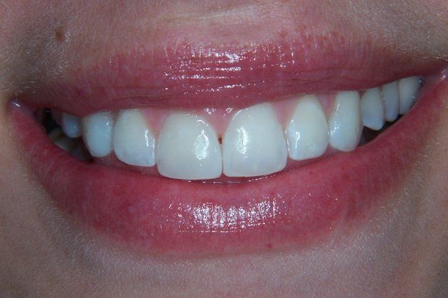 Cosmetic Bonding Photos, Case 10 Closing space between front teeth ...