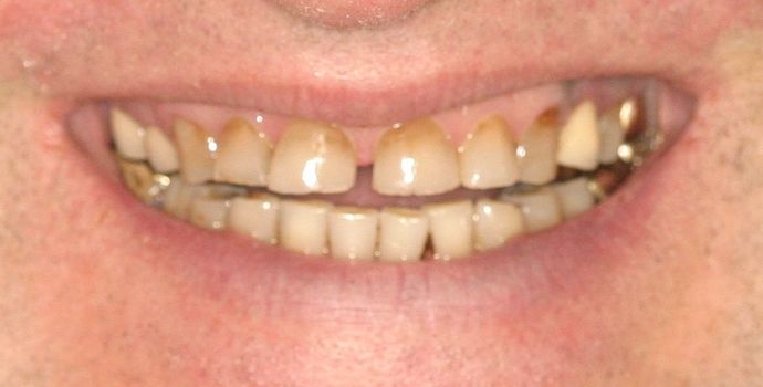 Cosmetic Dentistry: Case 2 - Kirk Before