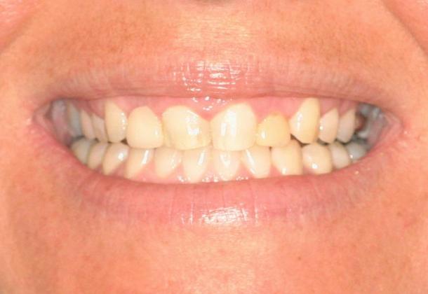 Cosmetic Dentistry: Case 3 - Angie Before