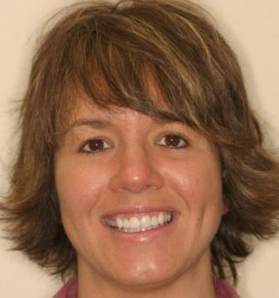 Cosmetic Dentistry: Case 3 - Angie After