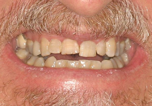 Cosmetic Dentistry: Case 4 - Before