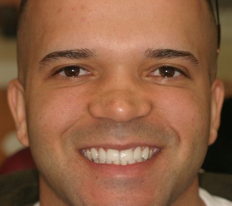 Cosmetic Dentistry: Case 5 - After