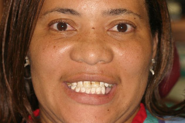 Cosmetic Dentistry: Case 6 - Before