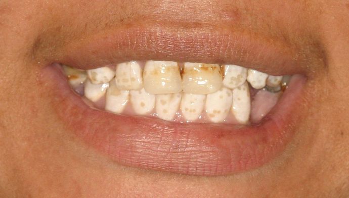 Cosmetic Dentistry: Case 6 - Before: Close Up
