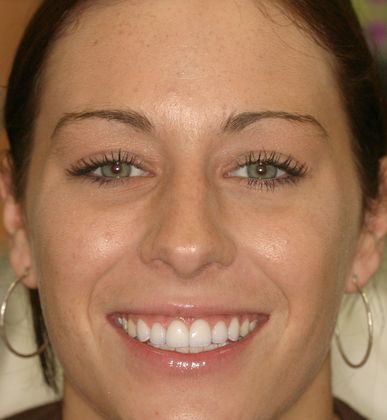 Cosmetic Dentistry: Case 7 - After