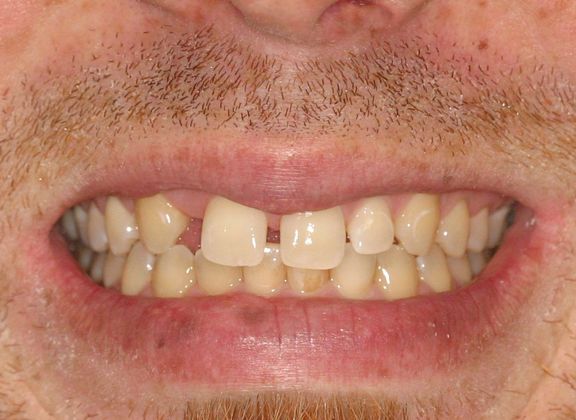 Replacing Missing Teeth Case 2 - Before