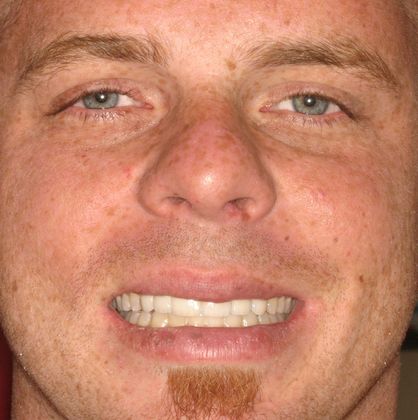 Replacing Missing Teeth Case 2 - After