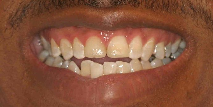 Cosmetic Dentistry: Case 8 - Before: Close Up