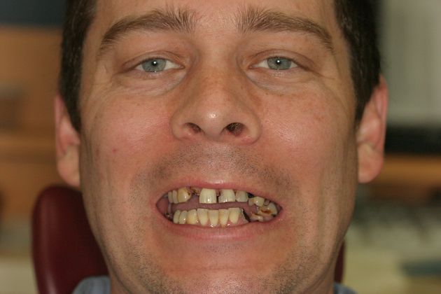 Replacing Missing Teeth Case 3 - Before