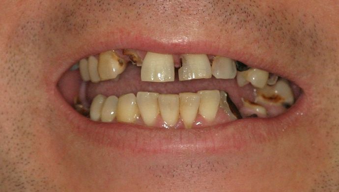 Replacing Missing Teeth Case 3 - After