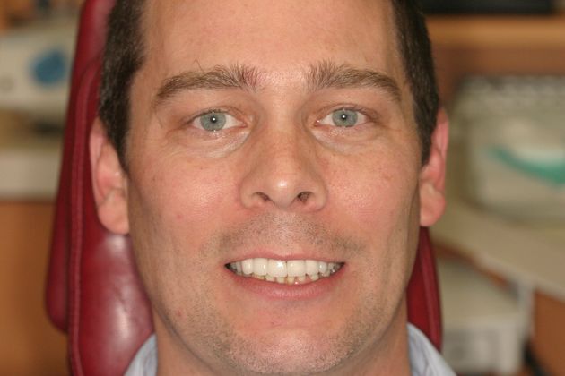 Replacing Missing Teeth: Case 3 - After