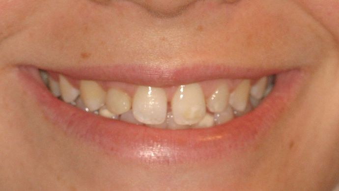 Cosmetic Dentistry: Case 9 - Before: Close Up