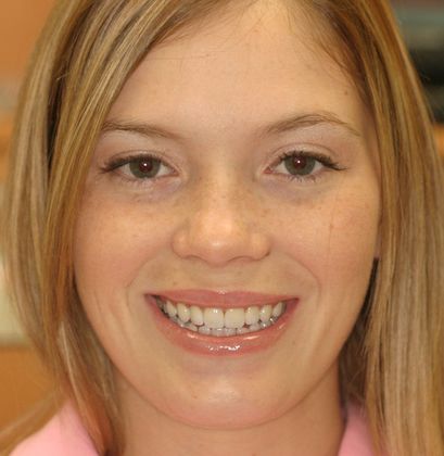 Cosmetic Dentistry: Case 9 - After